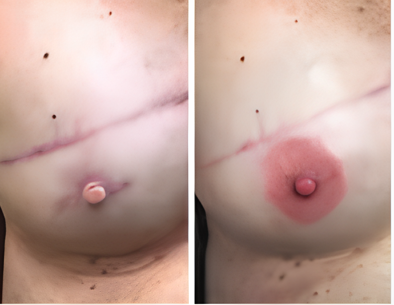 Peri medical tattoo