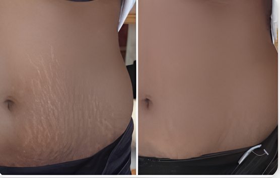 Scar before and after image