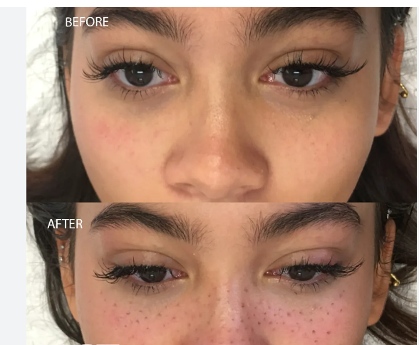 Freckles and beauty marks